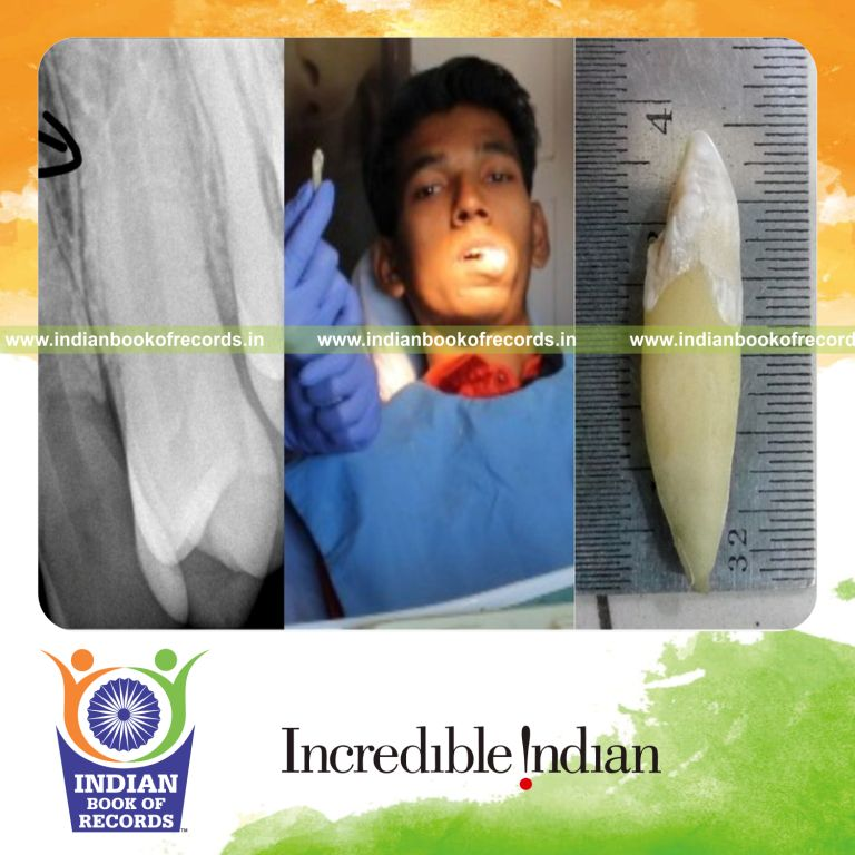 longest human tooth extracted recorded for Indian Book of Records
